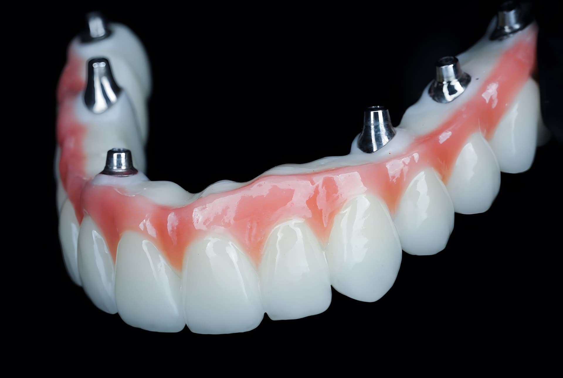Precision-crafted monolithic zirconia full-arch prosthesis
